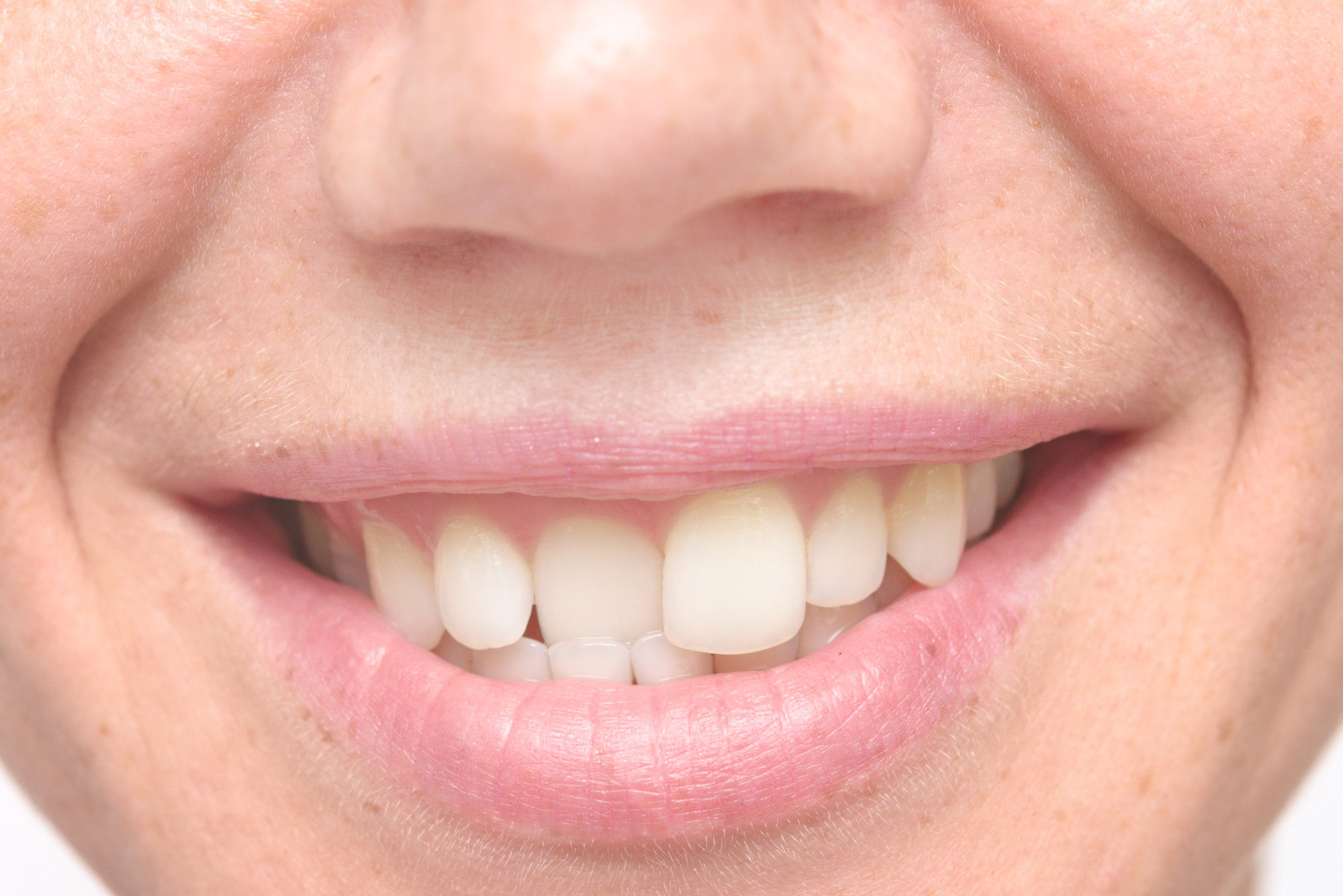 Different Types Of Crooked Teeth South Florida Coral Springs